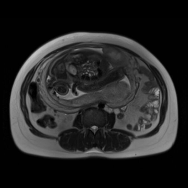 File:Bilobed placenta accreta (Radiopaedia 69648-79591 Axial T2 17).jpg