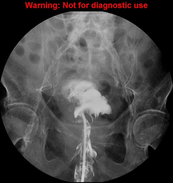 File:Bladder rupture (intraperitoneal) (Radiopaedia 41057-43807 cystogram 5).jpg