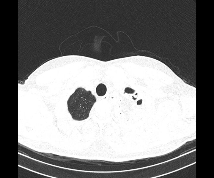 File:Bochdalek hernia - adult presentation (Radiopaedia 74897-85925 Axial lung window 4).jpg