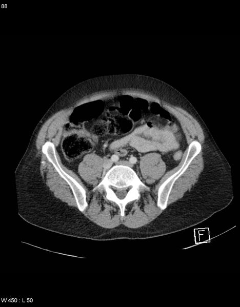 File:Boerhaave syndrome with tension pneumothorax (Radiopaedia 56794-63603 A 44).jpg
