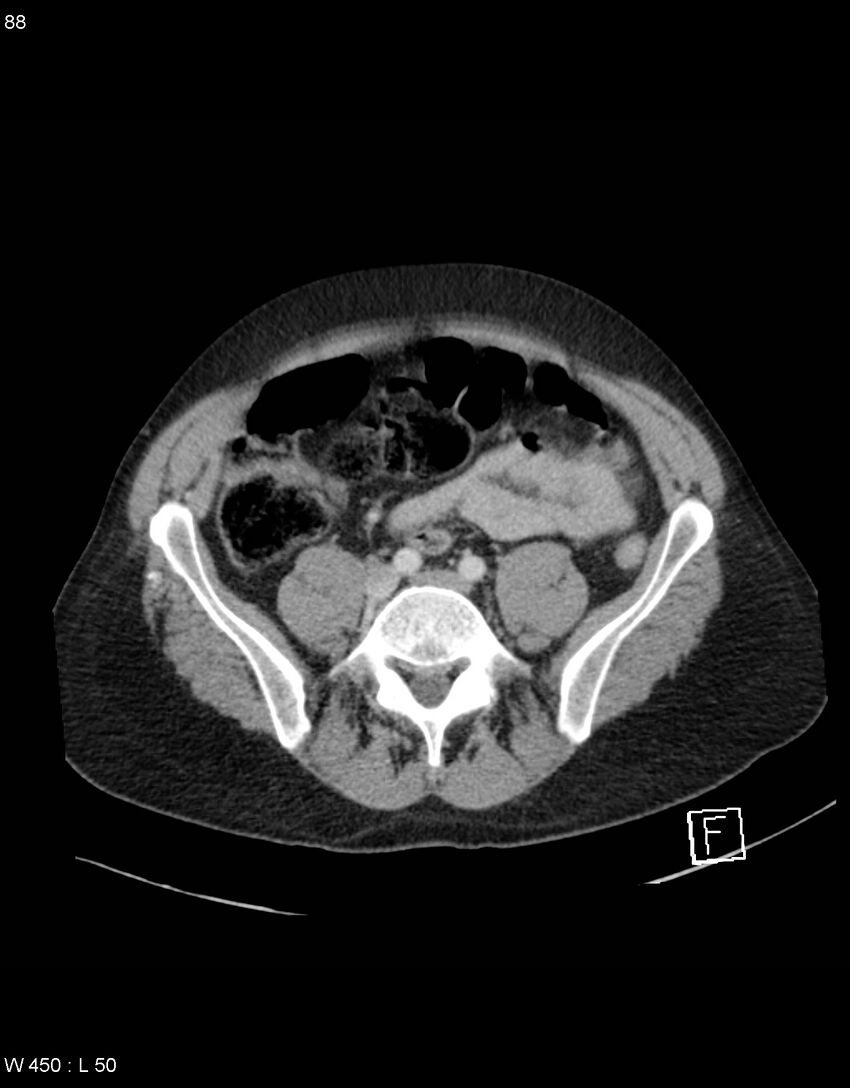 Boerhaave syndrome with tension pneumothorax (Radiopaedia 56794-63603 A 44).jpg
