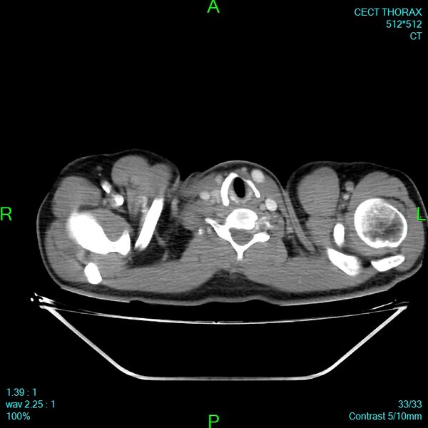 File:Bone metastases from lung carcinoma (Radiopaedia 54703-60937 Axial C+ delayed 33).jpg