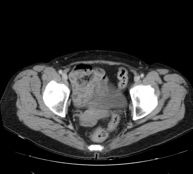 File:Bosniak renal cyst - type IV (Radiopaedia 22929-22953 C 62).jpg