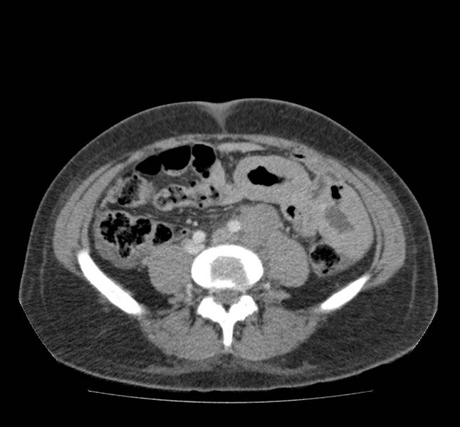 File:Bowel lymphoma complicated by bleeding after therapy (Radiopaedia 55601-62107 A 53).jpg