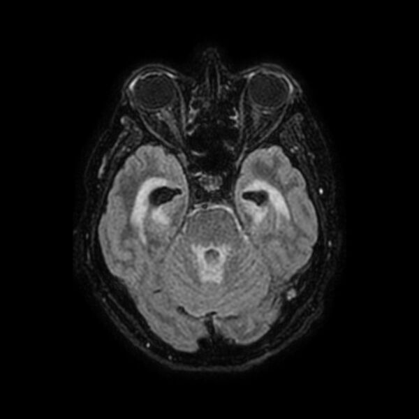 File:Brain abscess complicated by intraventricular rupture and ventriculitis (Radiopaedia 82434-96577 Axial FLAIR 19).jpg