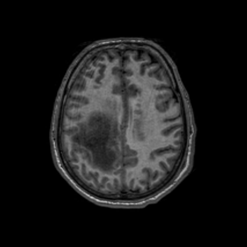 Brain abscess complicated by intraventricular rupture and ventriculitis (Radiopaedia 82434-96577 Axial T1 49).jpg