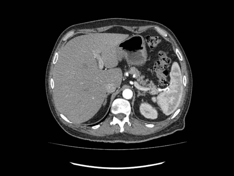 File:Brain metastases from renal cell carcinoma (Radiopaedia 42222-45328 A 7).jpg
