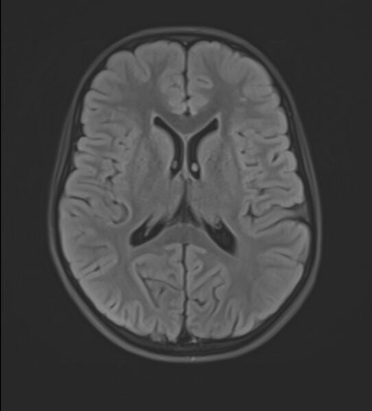 File:Brainstem glioma (Radiopaedia 70548-80674 Axial FLAIR 15).jpg