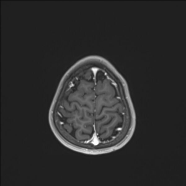 File:Brainstem glioma (Radiopaedia 70548-80674 Axial T1 C+ 137).jpg