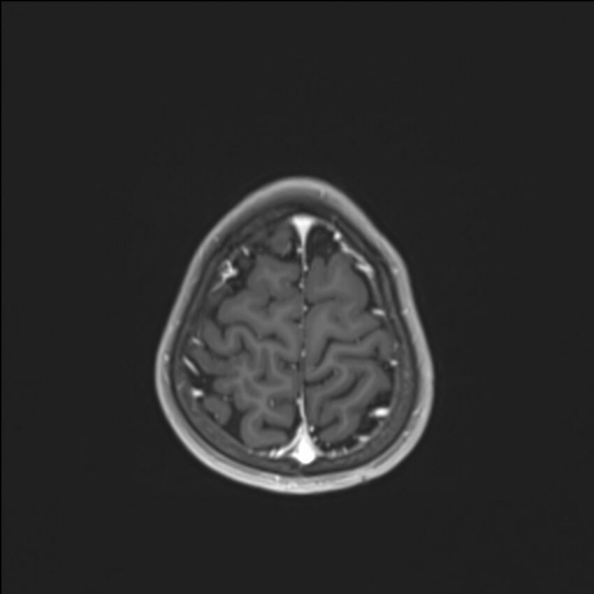 Brainstem glioma (Radiopaedia 70548-80674 Axial T1 C+ 137).jpg