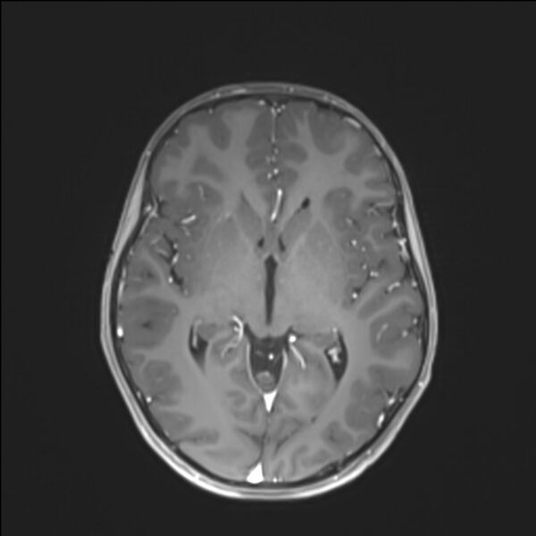 File:Brainstem glioma (Radiopaedia 70548-80674 Axial T1 C+ 80).jpg