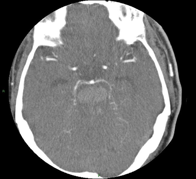 File:Brainstem hemorrhage (Radiopaedia 58794-66028 D 74).jpg