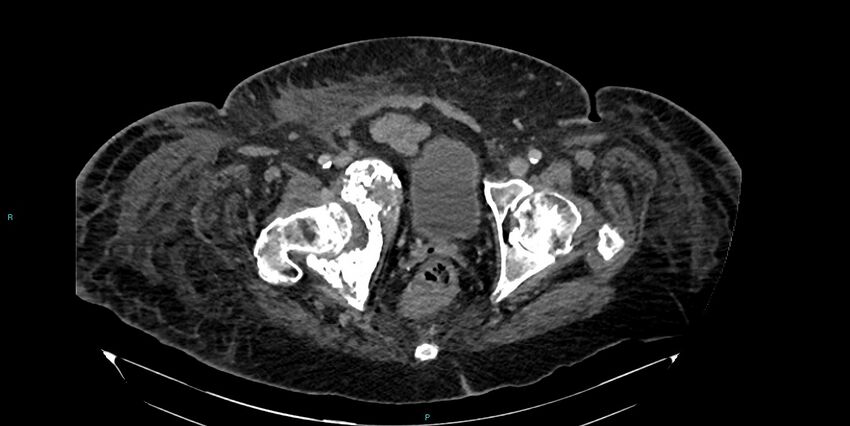 Breast cancer pelvic bony metastases (Radiopaedia 84470-99824 Axial bone window 59).jpg