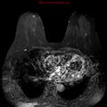 Breast carcinoma (multicentric multifocal in mammary Paget disease) (Radiopaedia 50966-56512 Axial T1 C+ fat sat 5).jpg