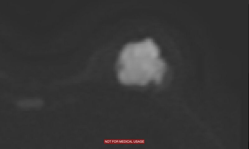 File:Breast lymphoma (MRI) (Radiopaedia 34999-36498 Axial DWI 5).jpg