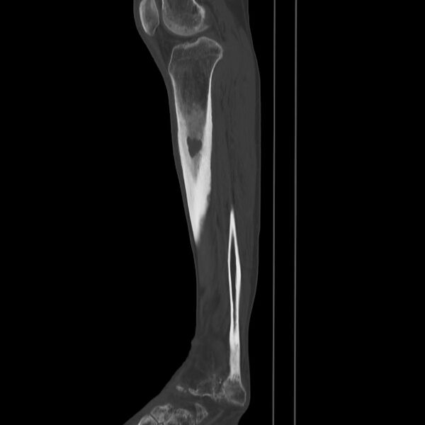 File:Brodie abscess - tibia (Radiopaedia 66028-75204 Sagittal bone window 47).jpg