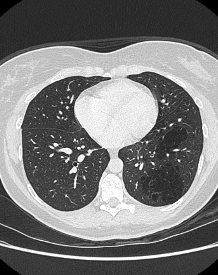 Bronchial atresia (Radiopaedia 50007-55297 Axial lung window 69).jpg