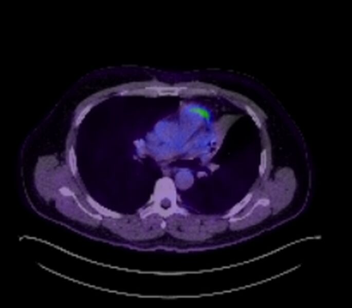 File:Bronchial carcinoid tumor (Radiopaedia 67377-76766 18FDG-PET-CT 26).jpg