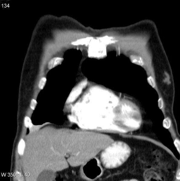 File:Bronchial carcinoid tumor with right lower lobe collapse (Radiopaedia 29060-29422 C 3).jpg