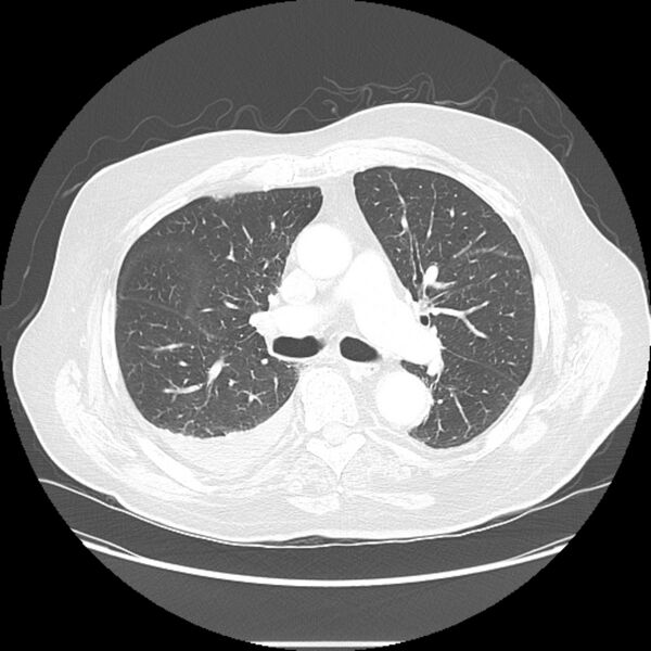 File:Bronchogenic adenocarcinoma and pulmonary embolism (Radiopaedia 9097-9806 Axial lung window 13).jpg