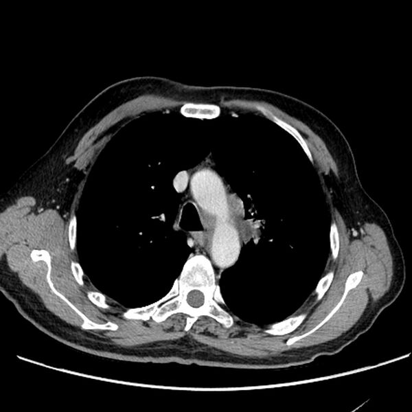 File:Bronchogenic carcinoma with L1 vertebra metastasis (Radiopaedia 9096-9805 Axial C+ delayed 9).jpg