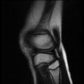 Bucket handle tear - lateral meniscus (Radiopaedia 72124-82634 Sagittal T2 2).jpg