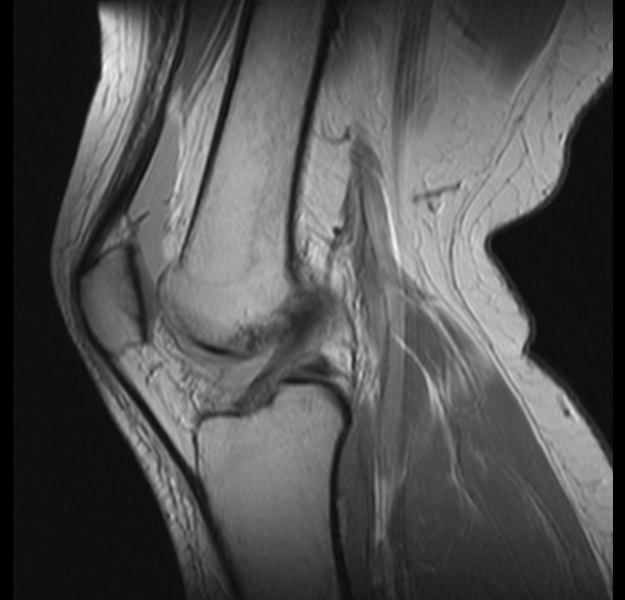 File:Bucket handle tear - medial meniscus (Radiopaedia 24900-25163 Sagittal T2 9).png