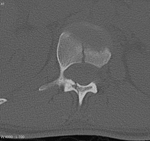 File:Burst fracture (Radiopaedia 5274-7018 Axial bone window 8).jpg