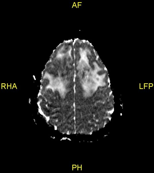 File:Butterfly glioma (Radiopaedia 76707-88526 Axial ADC 22).jpg