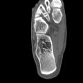 Calcaneal intraosseous lipoma (Radiopaedia 12746-12892 Axial bone window 1).jpeg