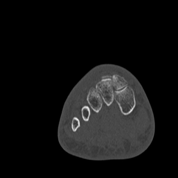 File:Calcaneal tuberosity avulsion fracture (Radiopaedia 22649-22668 Coronal bone window 31).jpg