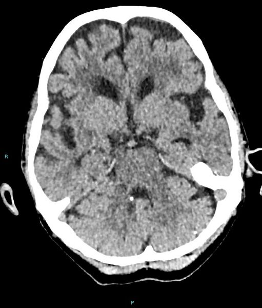 File:Calcified cerebral emboli from left ventricular thrombus (Radiopaedia 84420-99758 Axial non-contrast 63).jpg