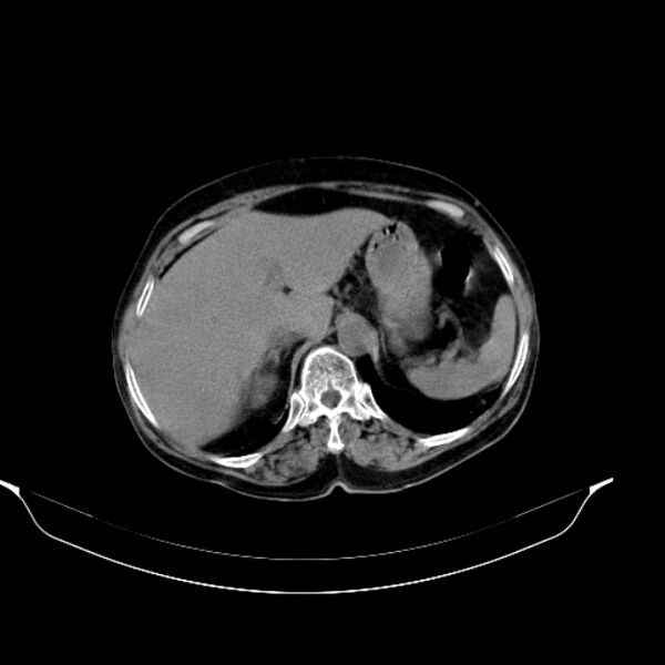 File:Calcified hydatid cyst (Radiopaedia 62000-70085 Axial non-contrast 30).jpg