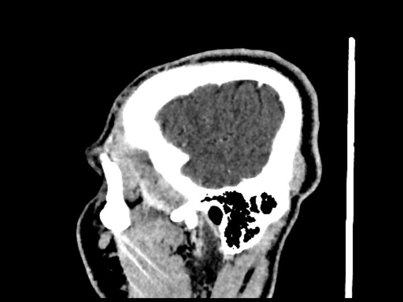 File:Capillary hemangioma of the orbit (Radiopaedia 44610-48358 C 2).jpg