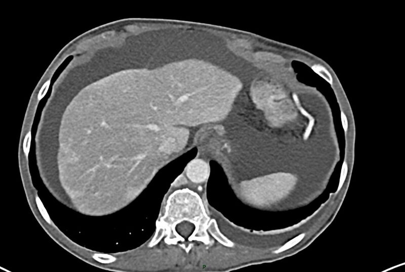 File:Carcinoid mesenteric tumor complicated by chylous ascites (Radiopaedia 76312-87953 A 9).jpg