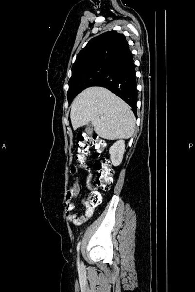 File:Carcinoma of uterine cervix (Radiopaedia 85861-101700 D 16).jpg