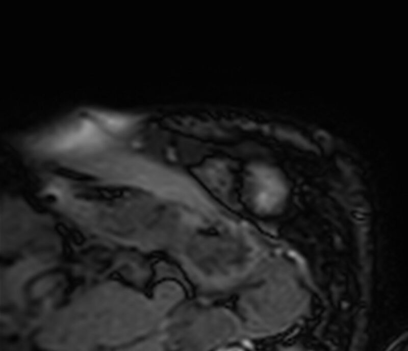 Cardiac amyloidosis (Radiopaedia 39736-42124 F 17).jpg