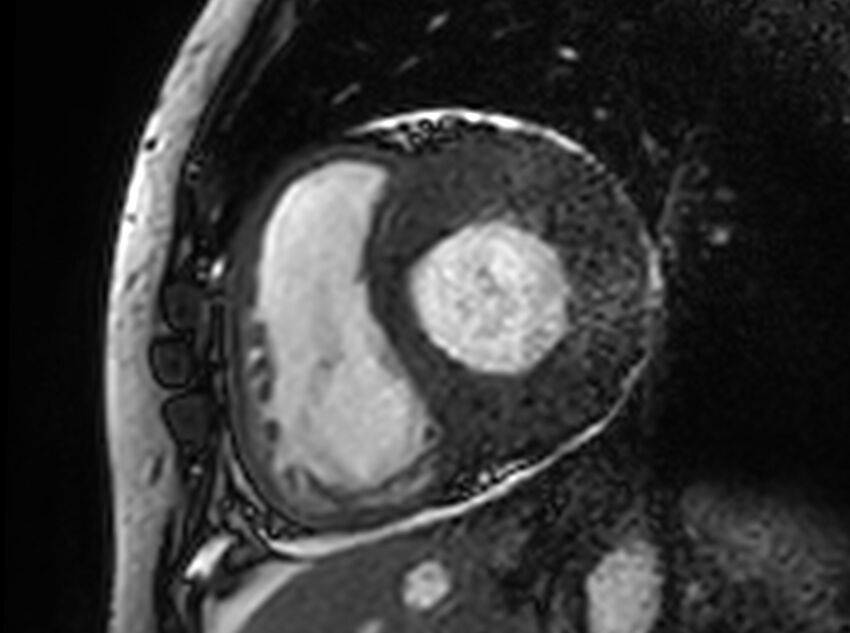 Cardiac amyloidosis (Radiopaedia 61600-69579 Short axis bSSFP 265).jpg