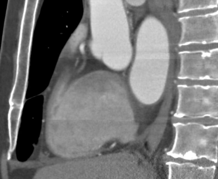 File:Cardiac hemangioma (Radiopaedia 16971-16679 C 15).JPG