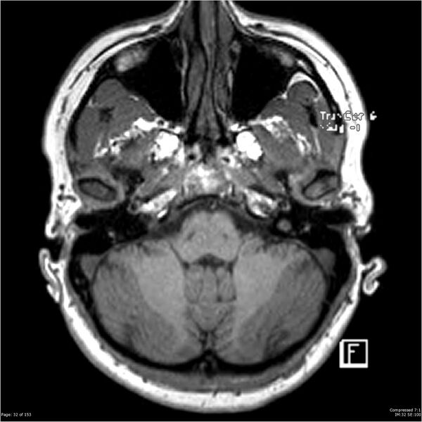 File:Cavernous malformation (cavernous angioma or cavernoma) (Radiopaedia 36675-38237 Axial T1 21).jpg