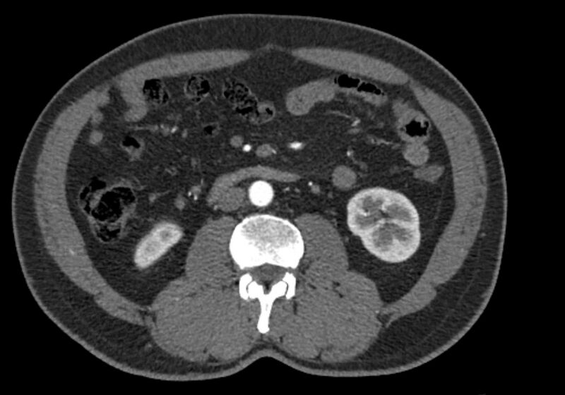 File:Celiac artery dissection (Radiopaedia 52194-58080 A 54).jpg