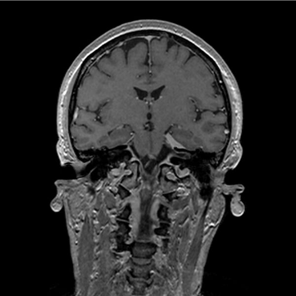 File:Central base of skull meningioma (Radiopaedia 53531-59549 Coronal T1 C+ 23).jpg