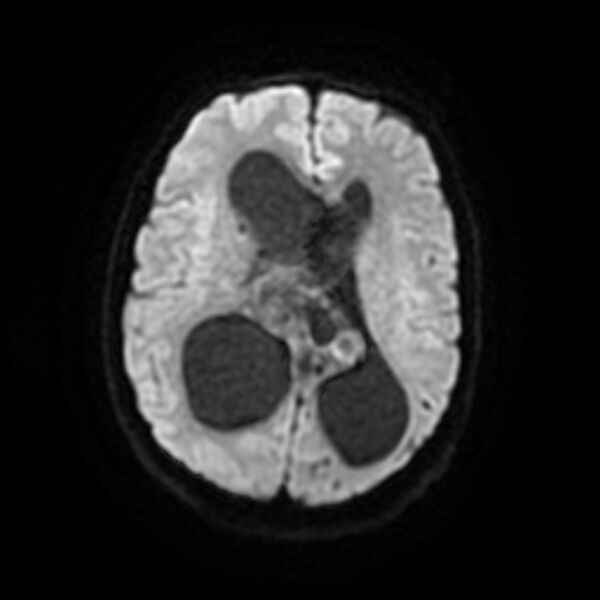 File:Central neurocytoma (Radiopaedia 67618-77021 Axial DWI 13).jpg
