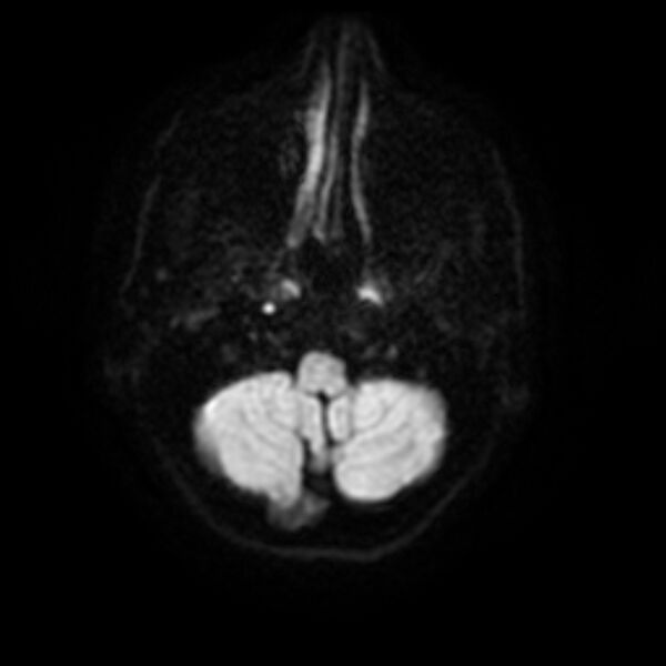 File:Central neurocytoma (Radiopaedia 67618-77021 Axial DWI 3).jpg