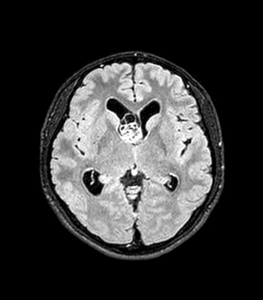File:Central neurocytoma (Radiopaedia 79320-92380 Axial FLAIR 167).jpg