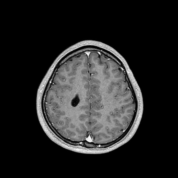File:Central neurocytoma (Radiopaedia 79320-92380 Axial T1 C+ 181).jpg