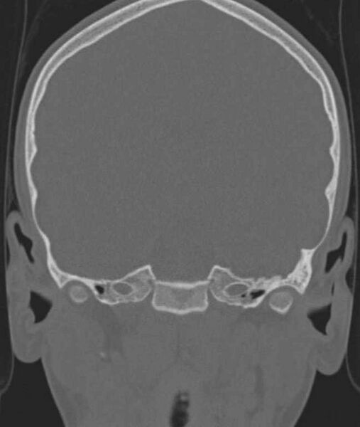 File:Cerebellar abscess (Radiopaedia 73727-84527 Coronal bone window 83).jpg