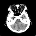 Cerebellar abscess secondary to mastoiditis (Radiopaedia 26284-26412 Axial non-contrast 33).jpg
