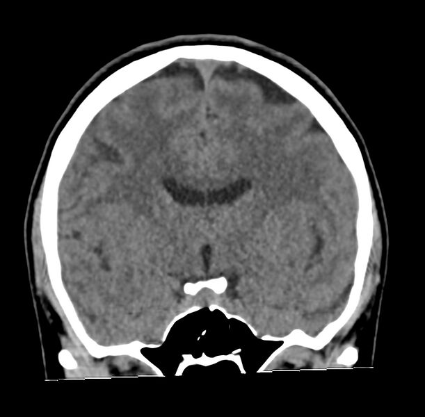 File:Cerebellar agenesis (Radiopaedia 30203-30817 Coronal non-contrast 15).jpg