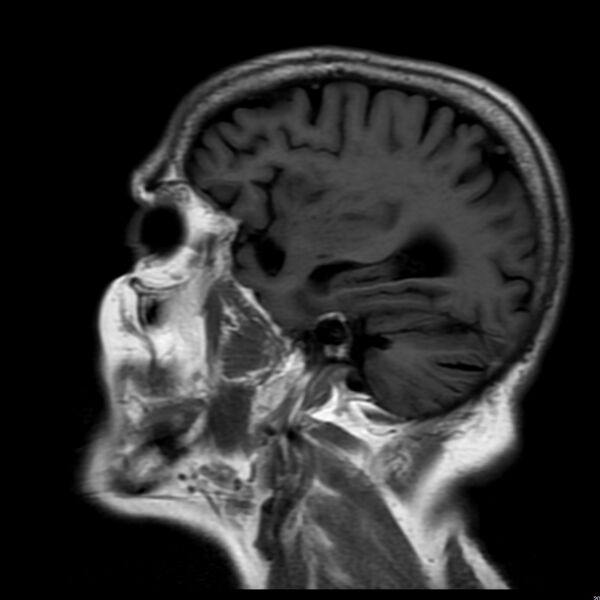 File:Cerebellar ataxia with neuropathy and vestibular areflexia syndrome (CANVAS) (Radiopaedia 74283-85159 Sagittal FLAIR 6).jpg